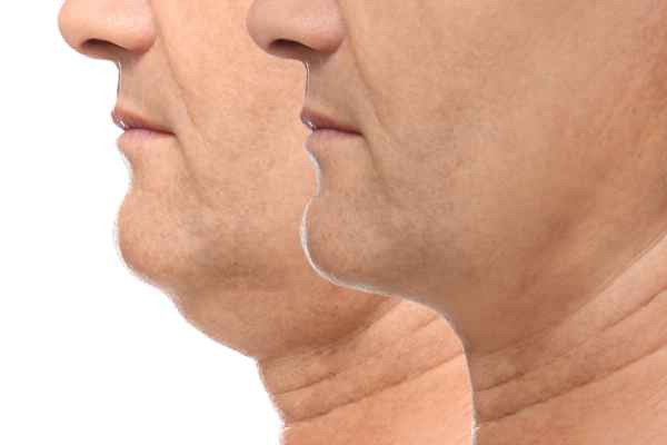 HIFU - Breakthrough in Anti - ageing 2 hifu results Lowestoft