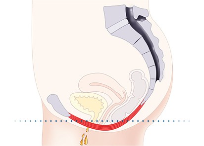 Pelvic-Floor Muscle Repair 5 Pelvic floor muscles Lowestoft