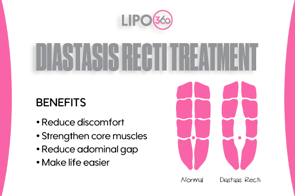 Revolutionising Muscle Repair: The Power of LIPO360 Body Sculpt Post-Injury 5 diastasis recti treatment Lowestoft