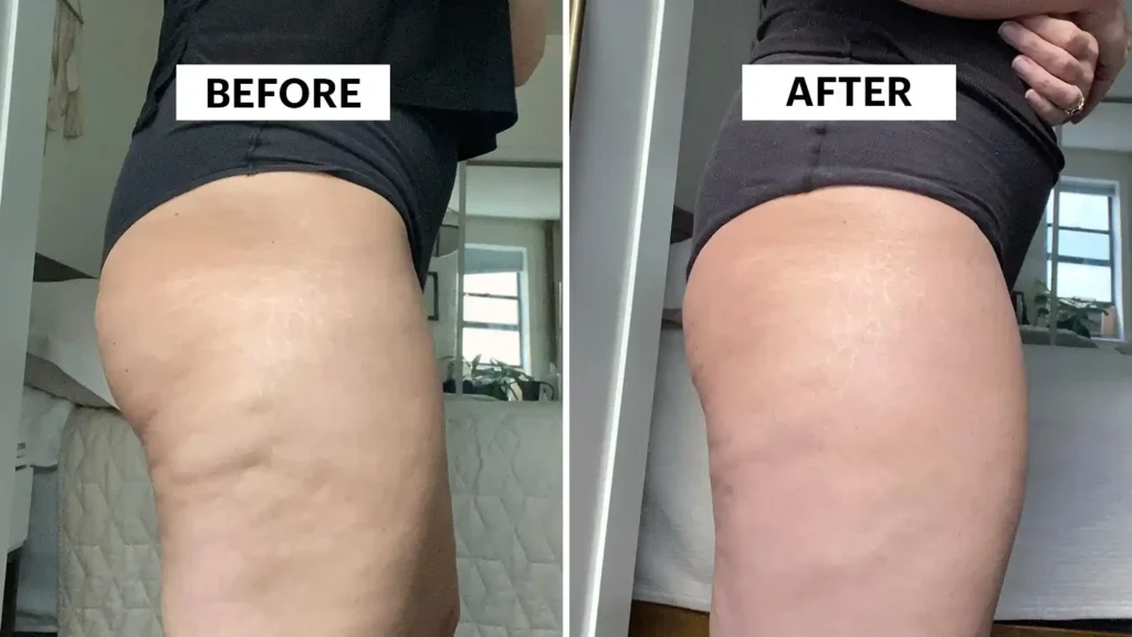 Do Toning Exercise Lowestoft Really Tackle Cellulite?