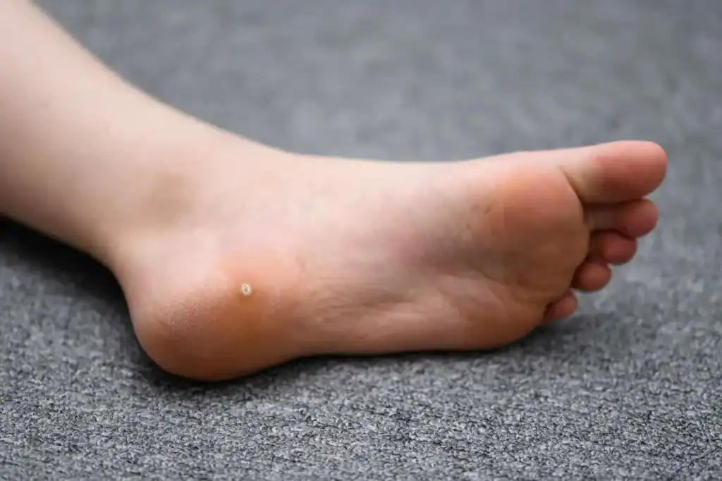 Cryotherapy For Warts And Also Verrucas 2 Image of verruca on the bottom of the foot that able to be treated with Cryotherapy Lowestoft
