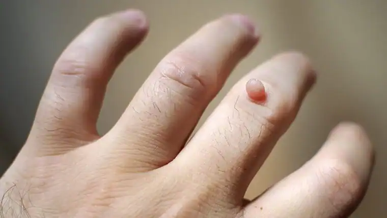 Cryotherapy For Warts And Also Verrucas 1 Image of blemish that Cryotherapy Lowestoft can remove with Lipo 360.