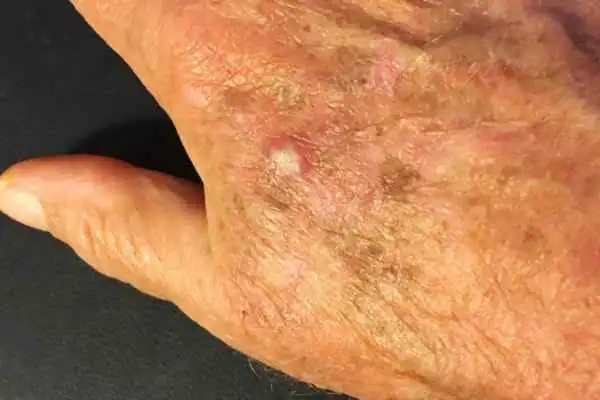 Cryopen For Actinic Keratoses 1 Image of Actinic keratoses Lowestoft on a person hand