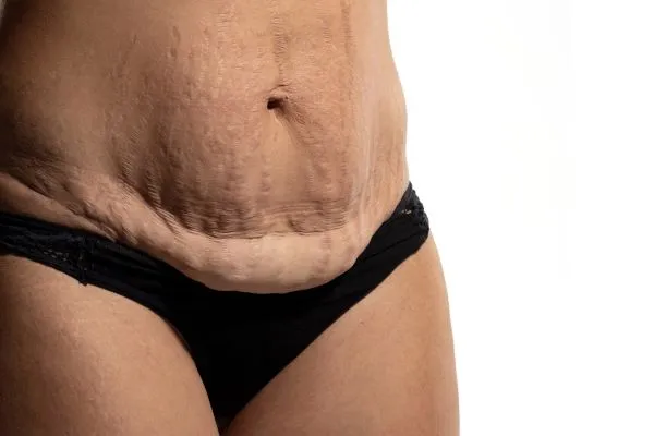 The Science of Skin Tightening 1 The science behind skin tightening Lowestoft picture of a woman's sagging skin on the stomach